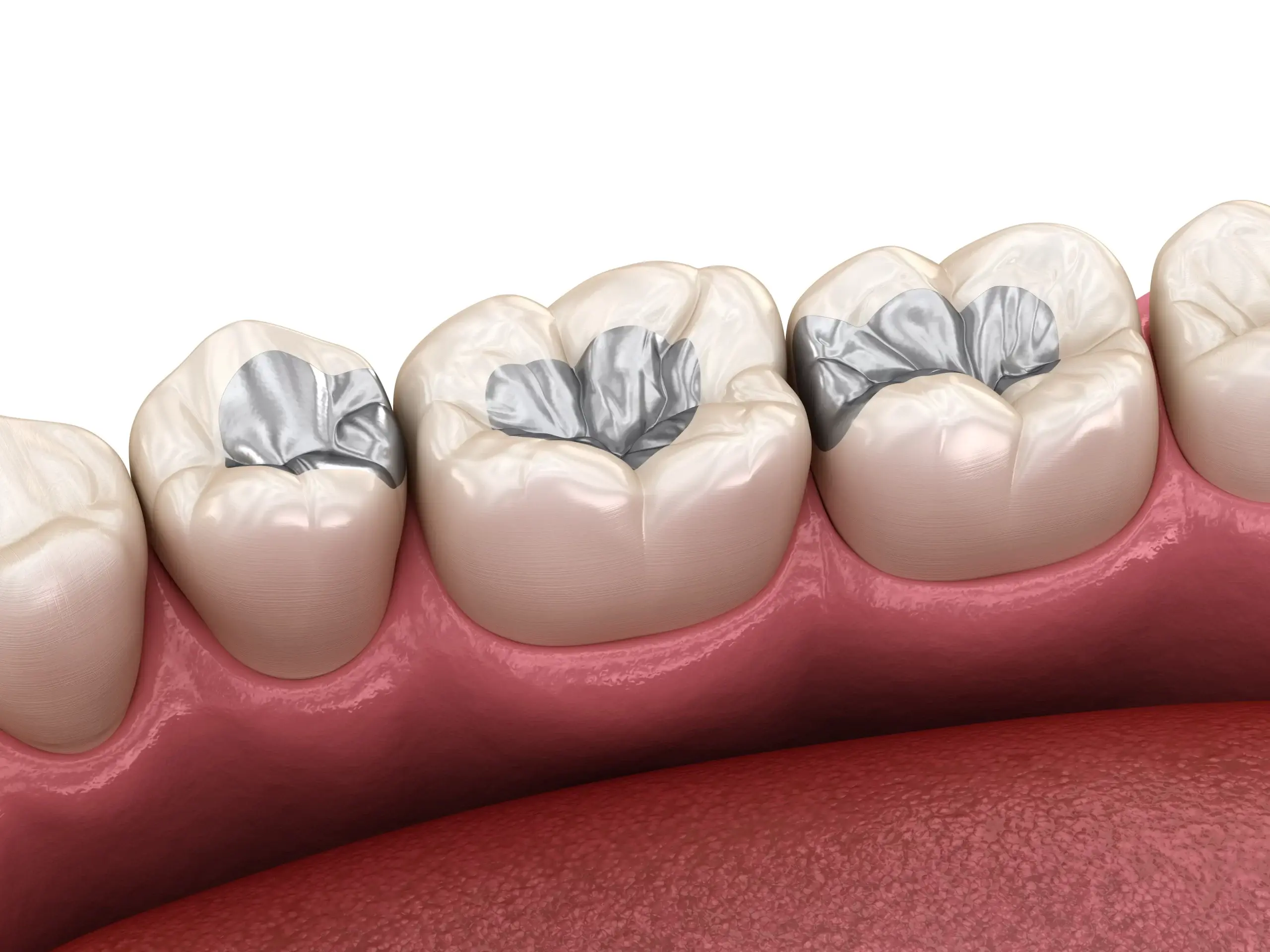 Fillings
