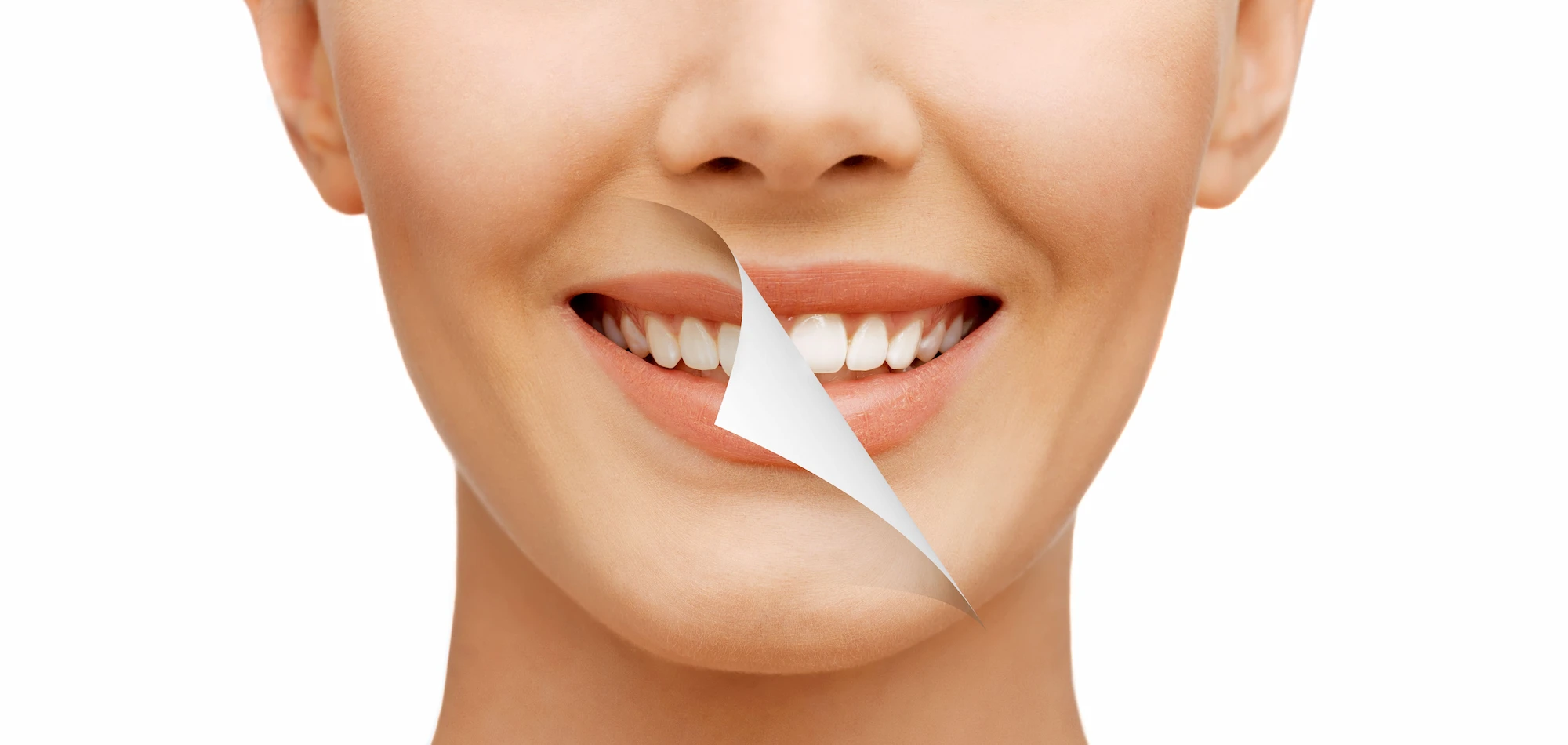Veneers