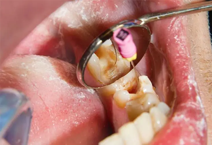 Re-Root Canal