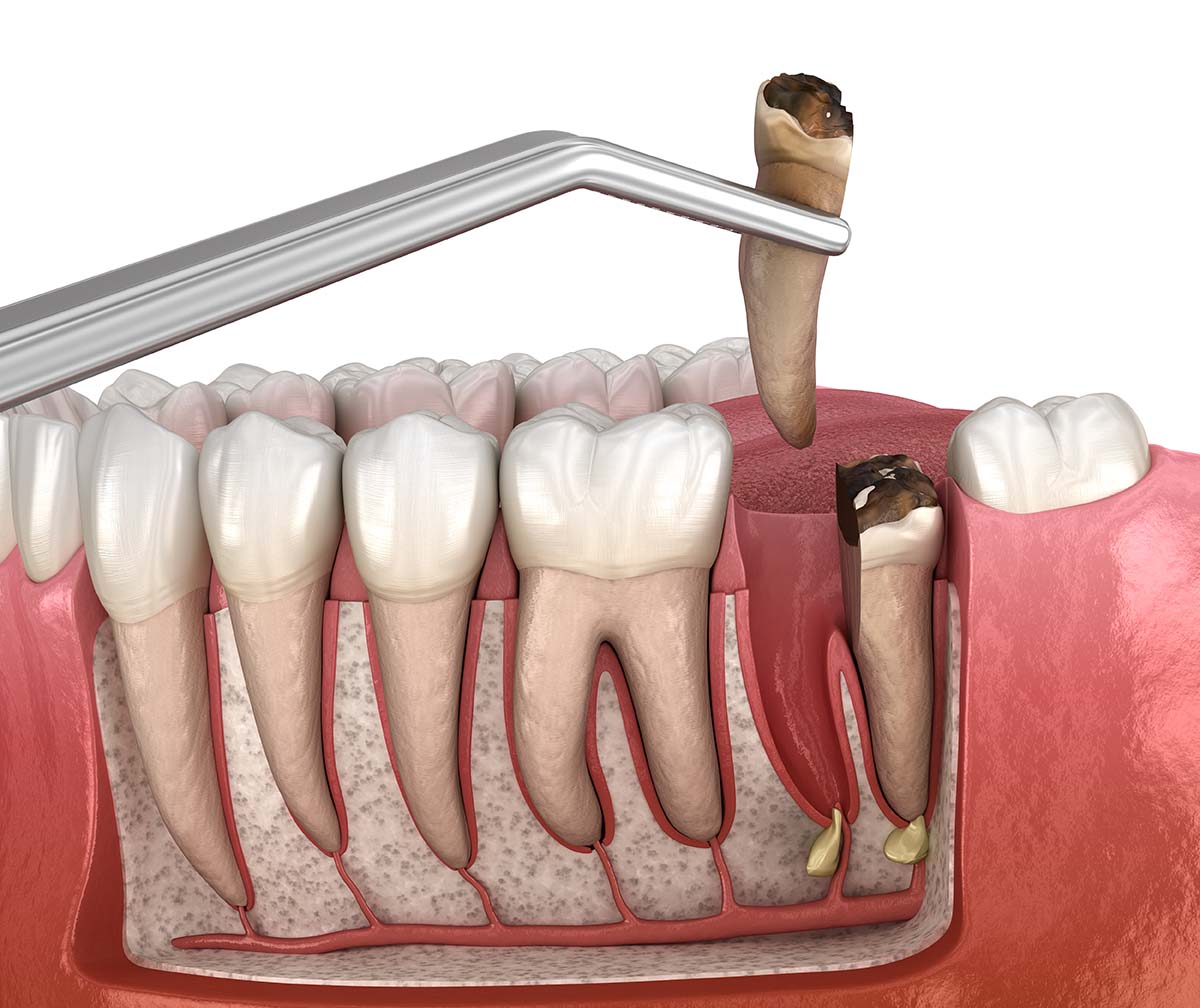 Wisdom Tooth