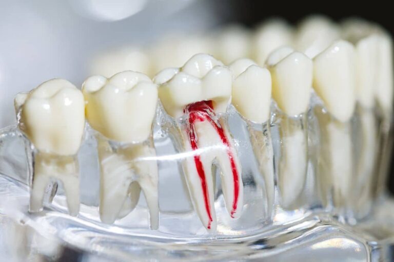 Why Root Canal Treatments Sometimes Fail and How to Ensure Success